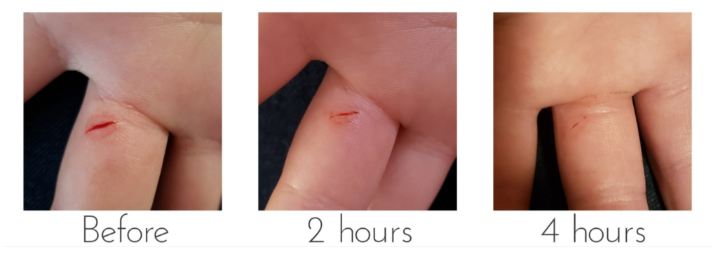 Rapid healing of finger cut